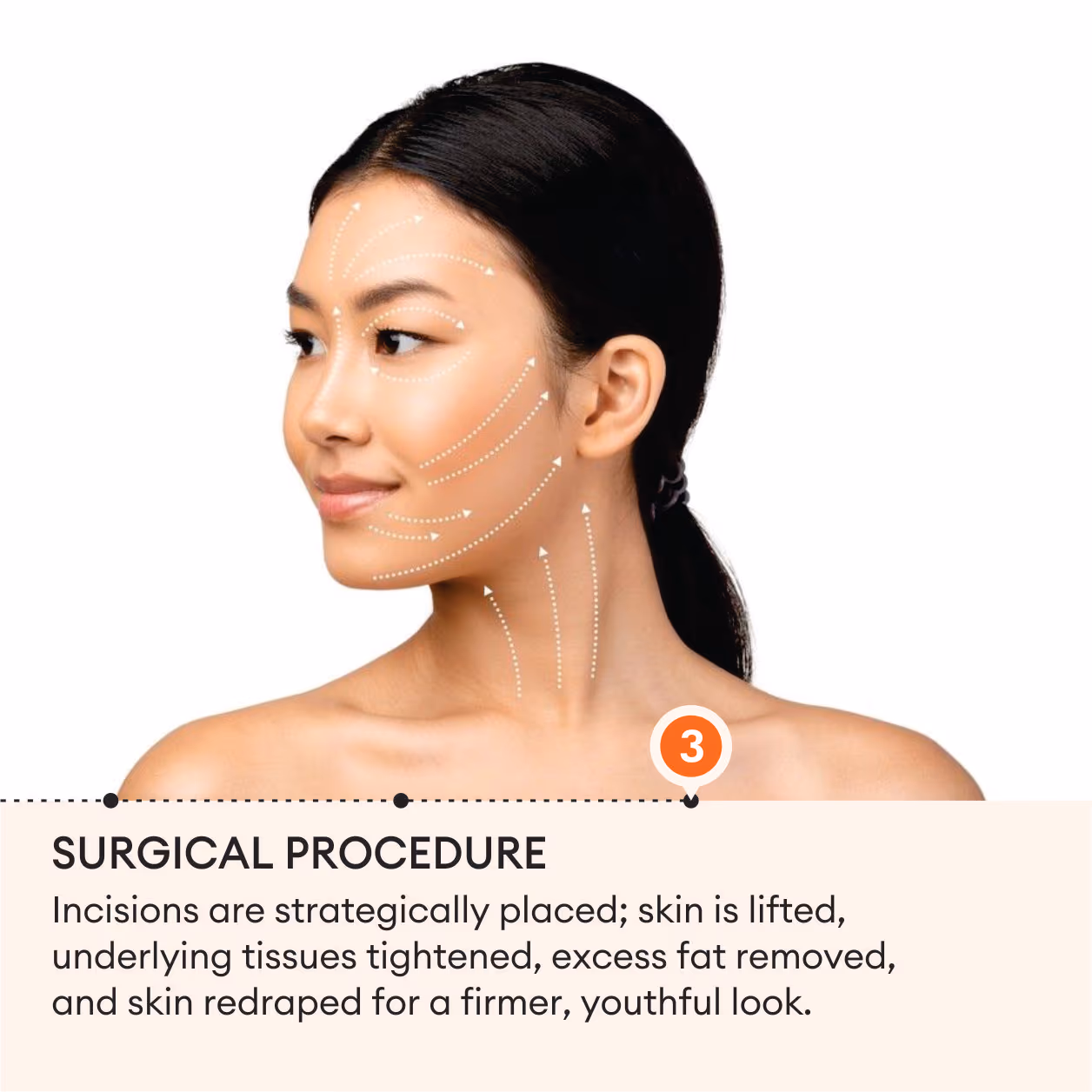 Face Lift Surgery 6