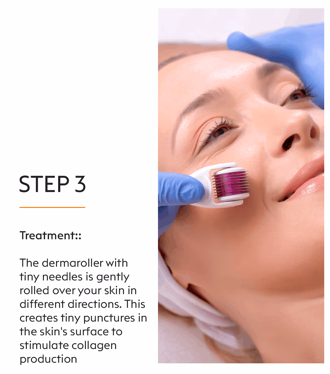 Derma Roller Microneedling Treatment 5