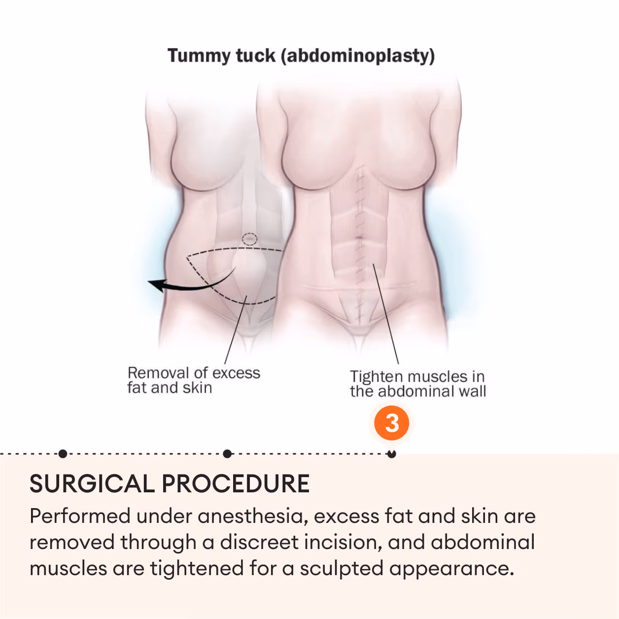Tummy Tuck Surgery (Abdominoplasty) 5