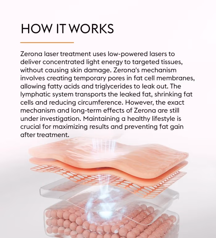 Fat Loss Zerona Laser Treatment 2