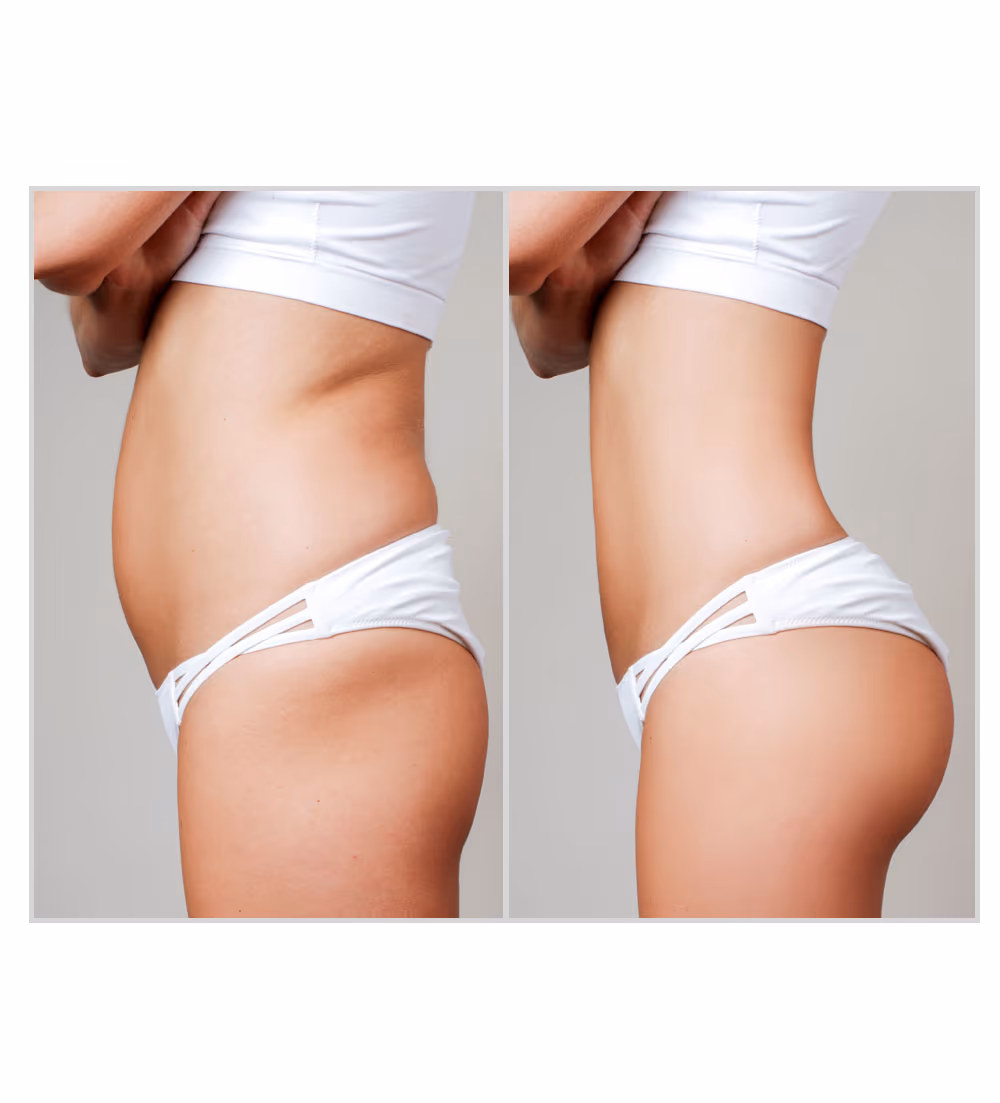 Lipozero Fat Loss Treatment 1