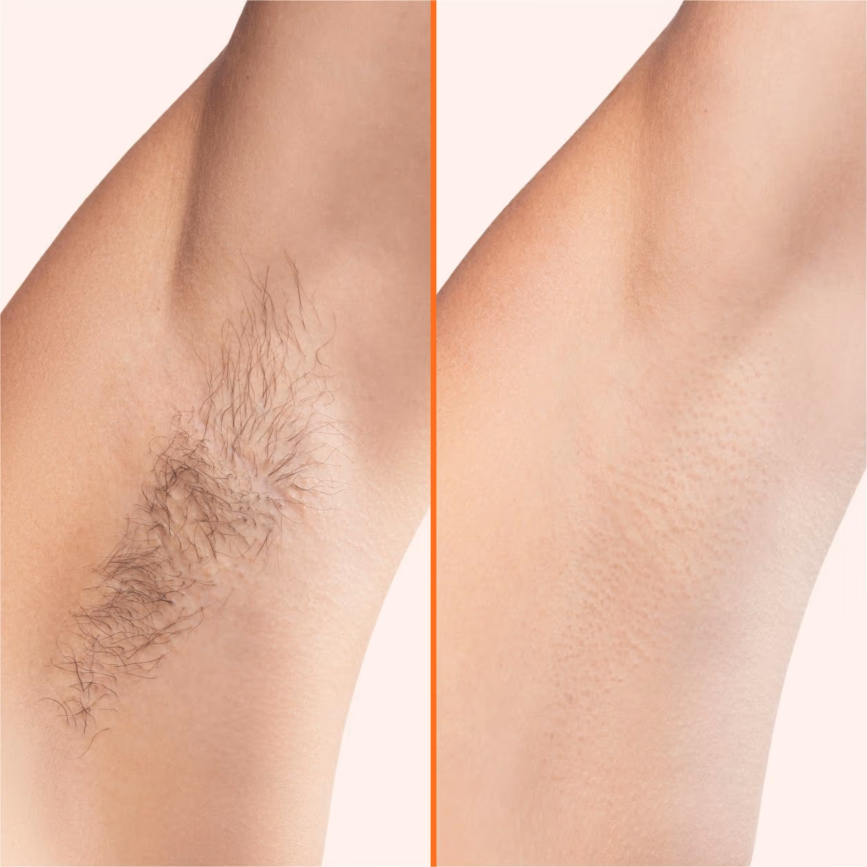 Laser Hair Reduction 1
