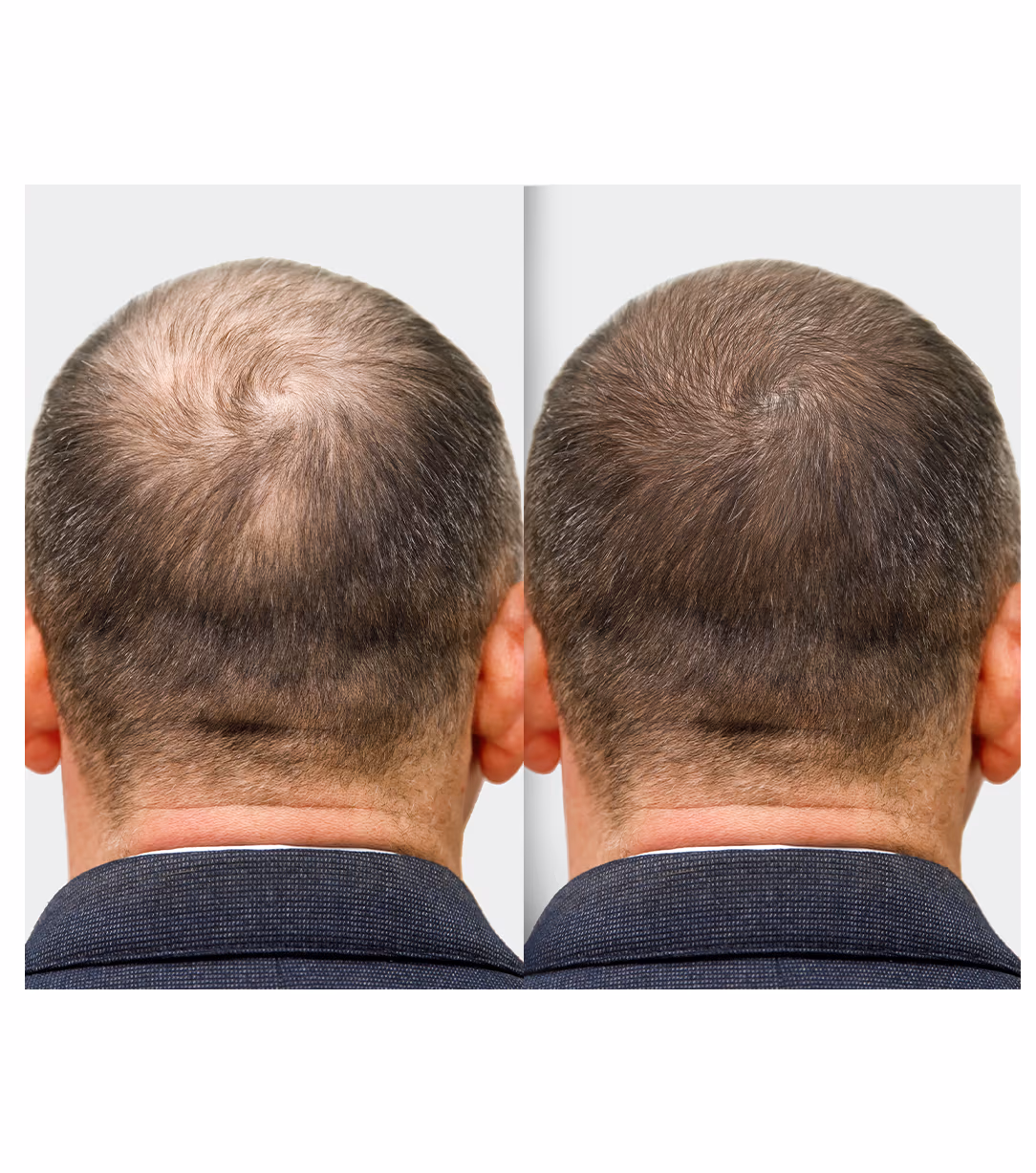 GFC Hair Fall Treatment 1