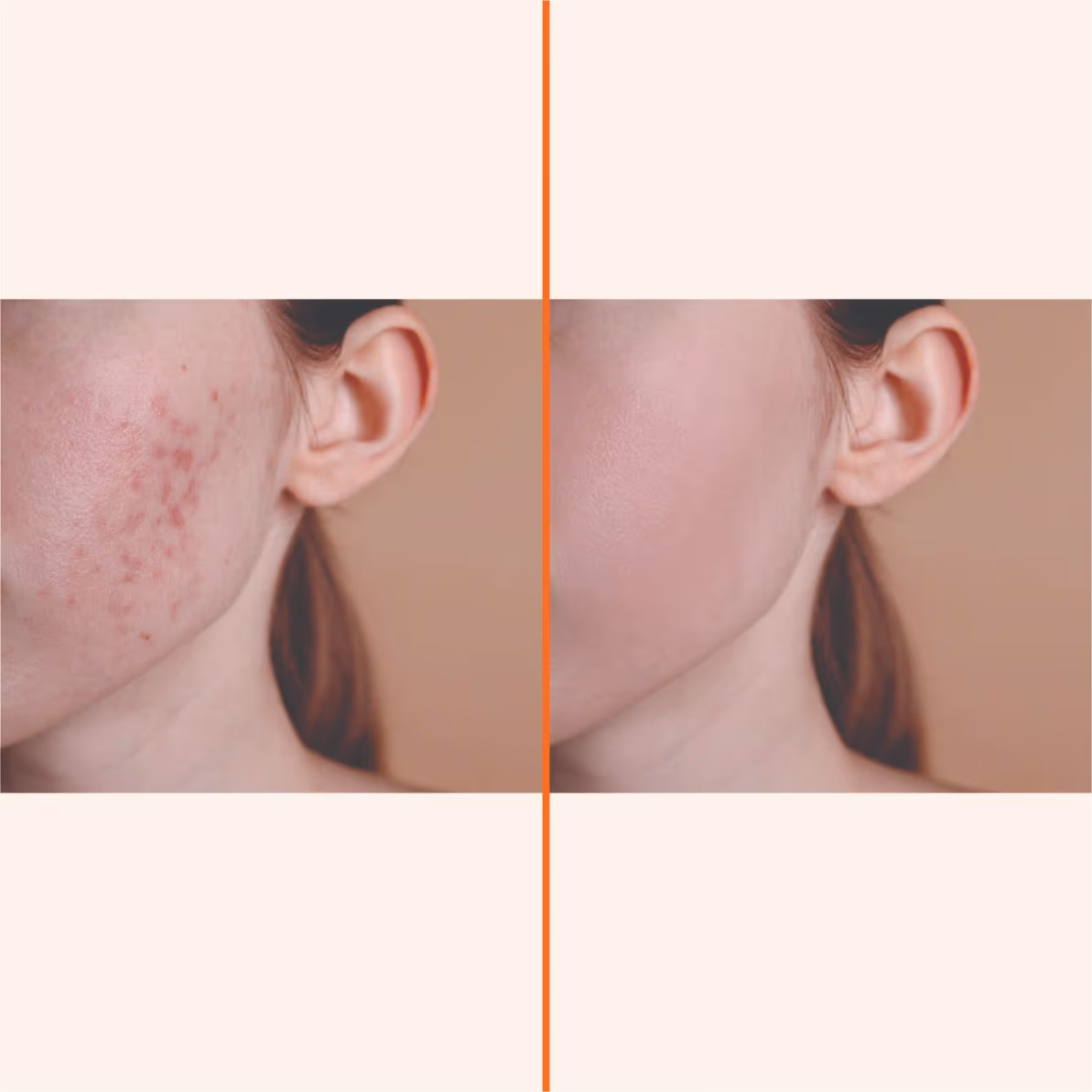 Microneedling 1