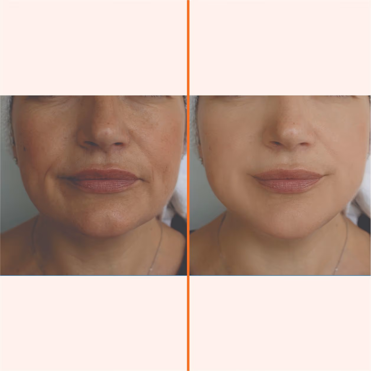 Bio Filler 1