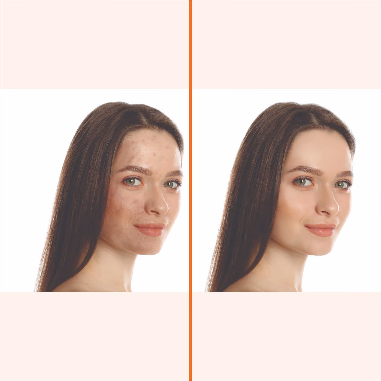 Chemical Peels 1