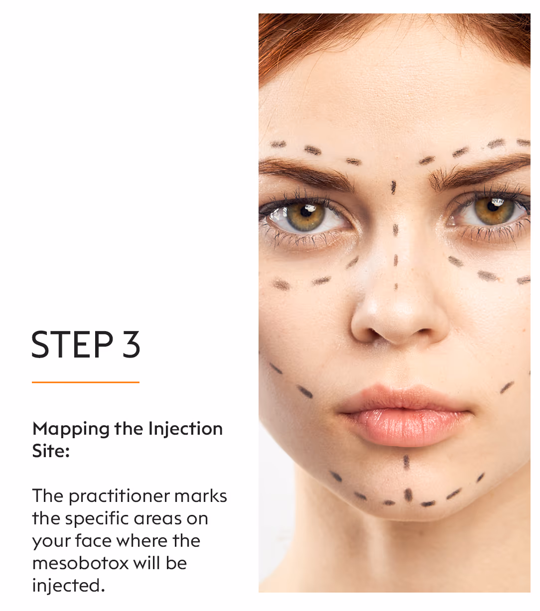 Mesobotox 5