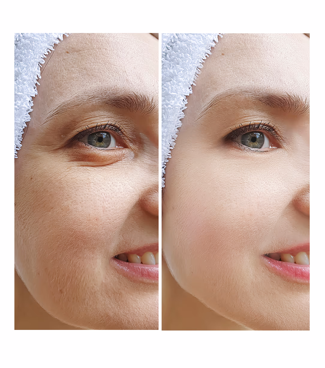 Thread Lift 1