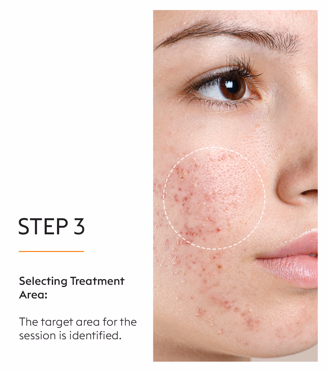 PRP Treatment for Face: Platelet Rich Plasma Therapy at VLCC 5