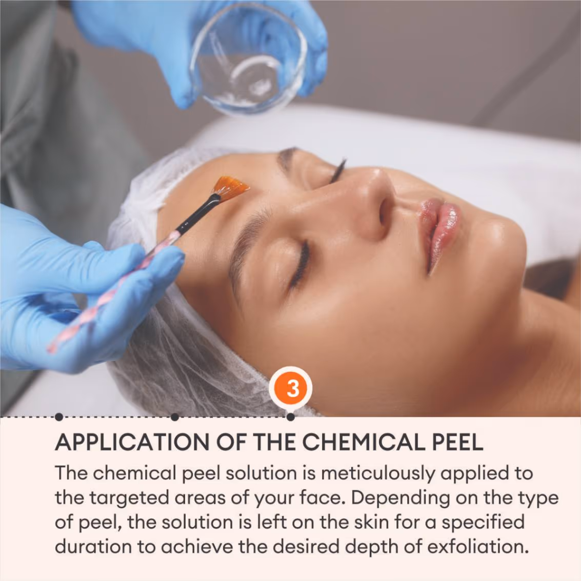 Chemical Peels 5