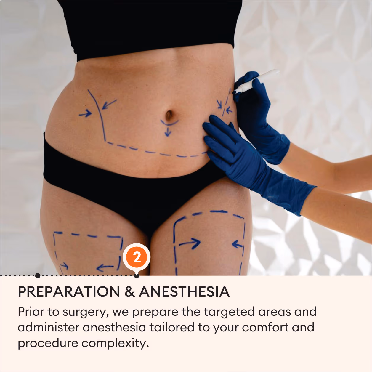 Liposuction Surgery 5