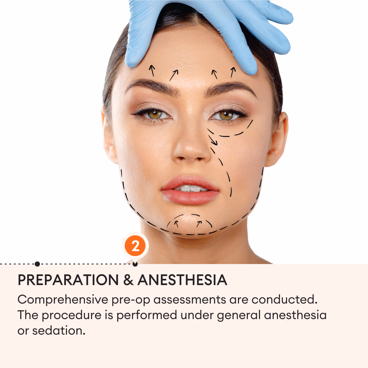 Face Lift Surgery 5