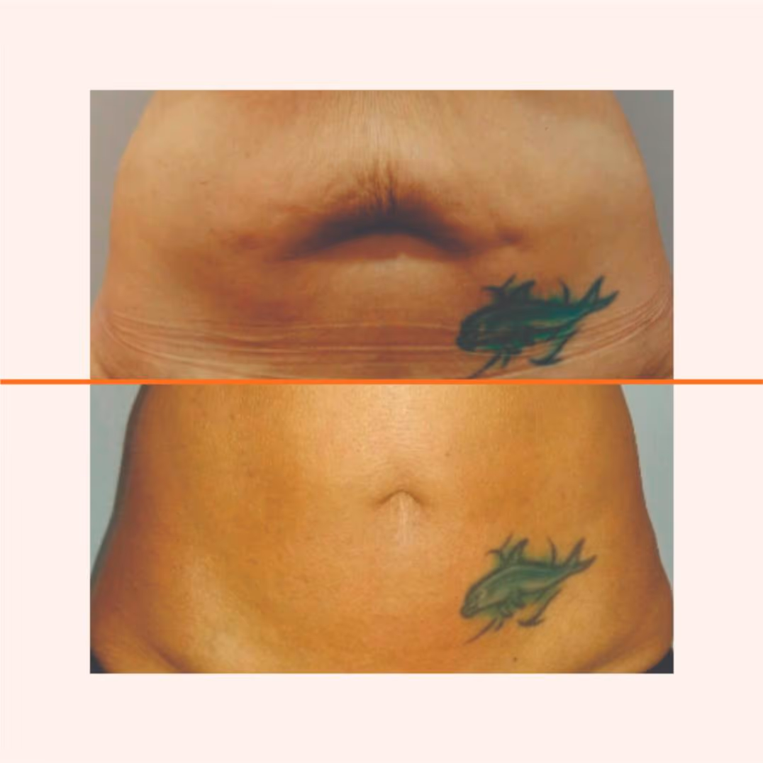 Lipozero 5D 1