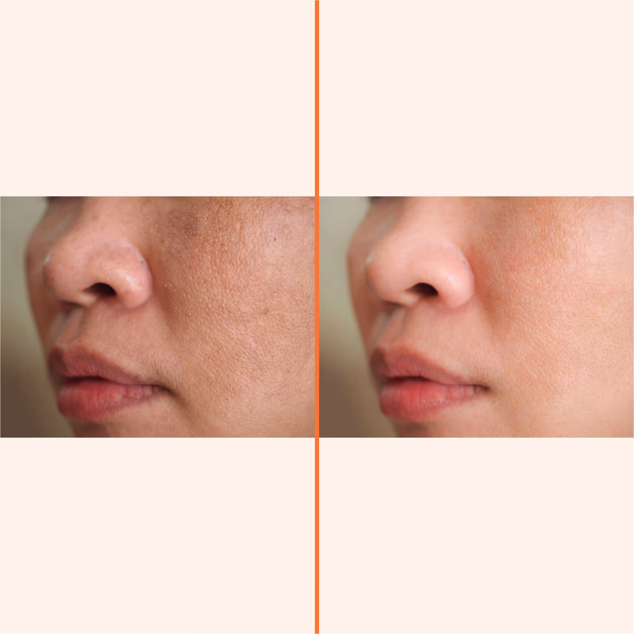 Ixora Facial 1