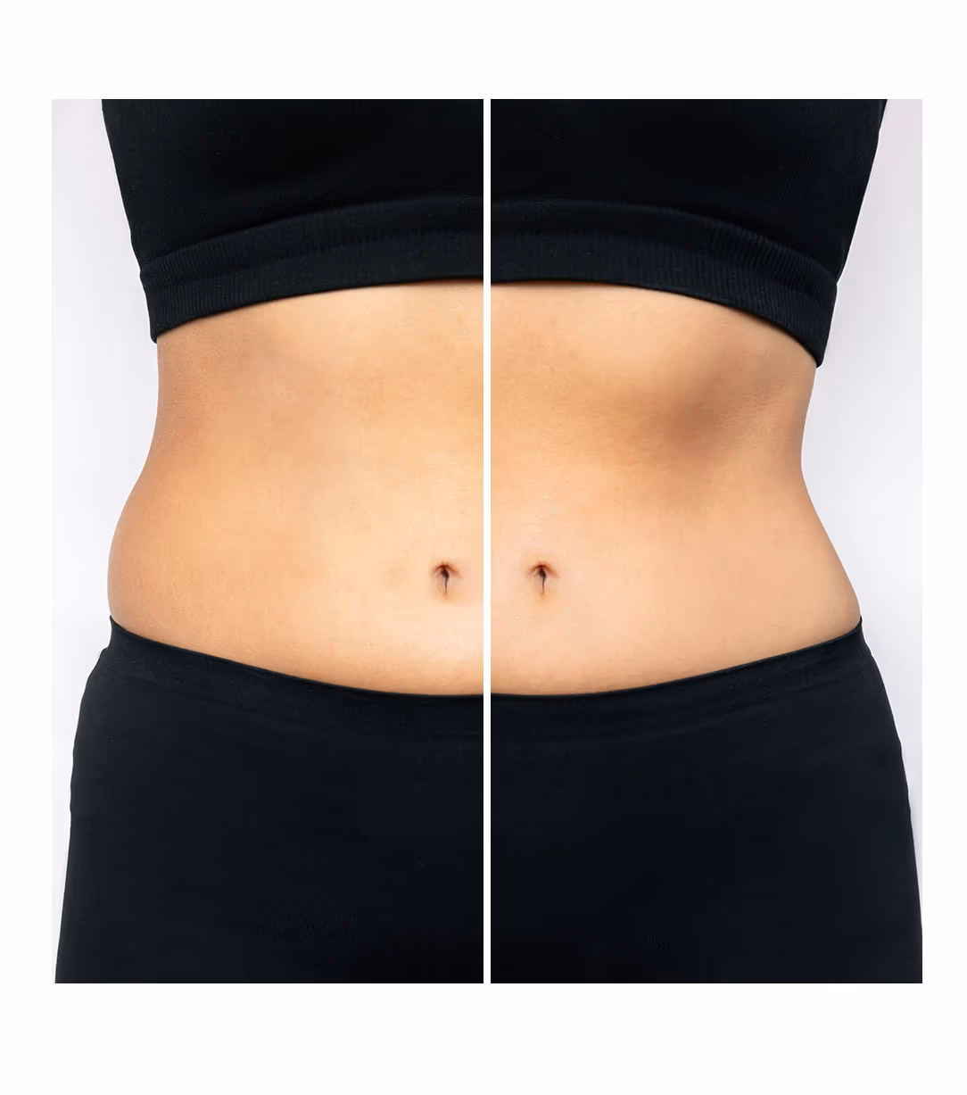 Fat Lipo Injectable 1