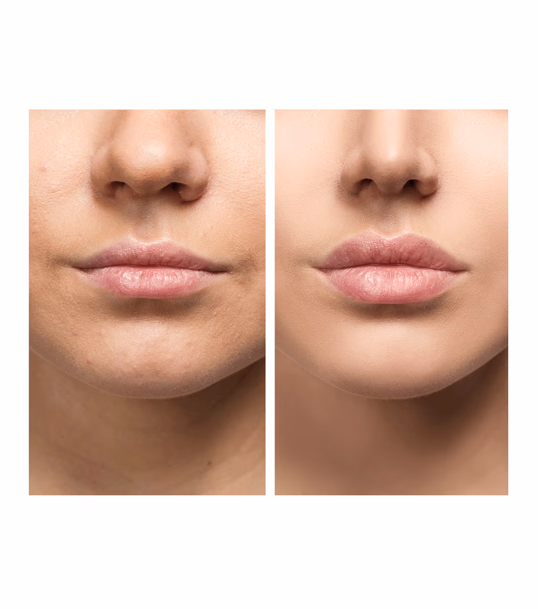 Face Fillers Injection Treatment 1