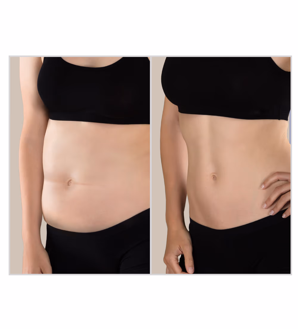 M-Tone Skin & Muscle Toning Treatment 1