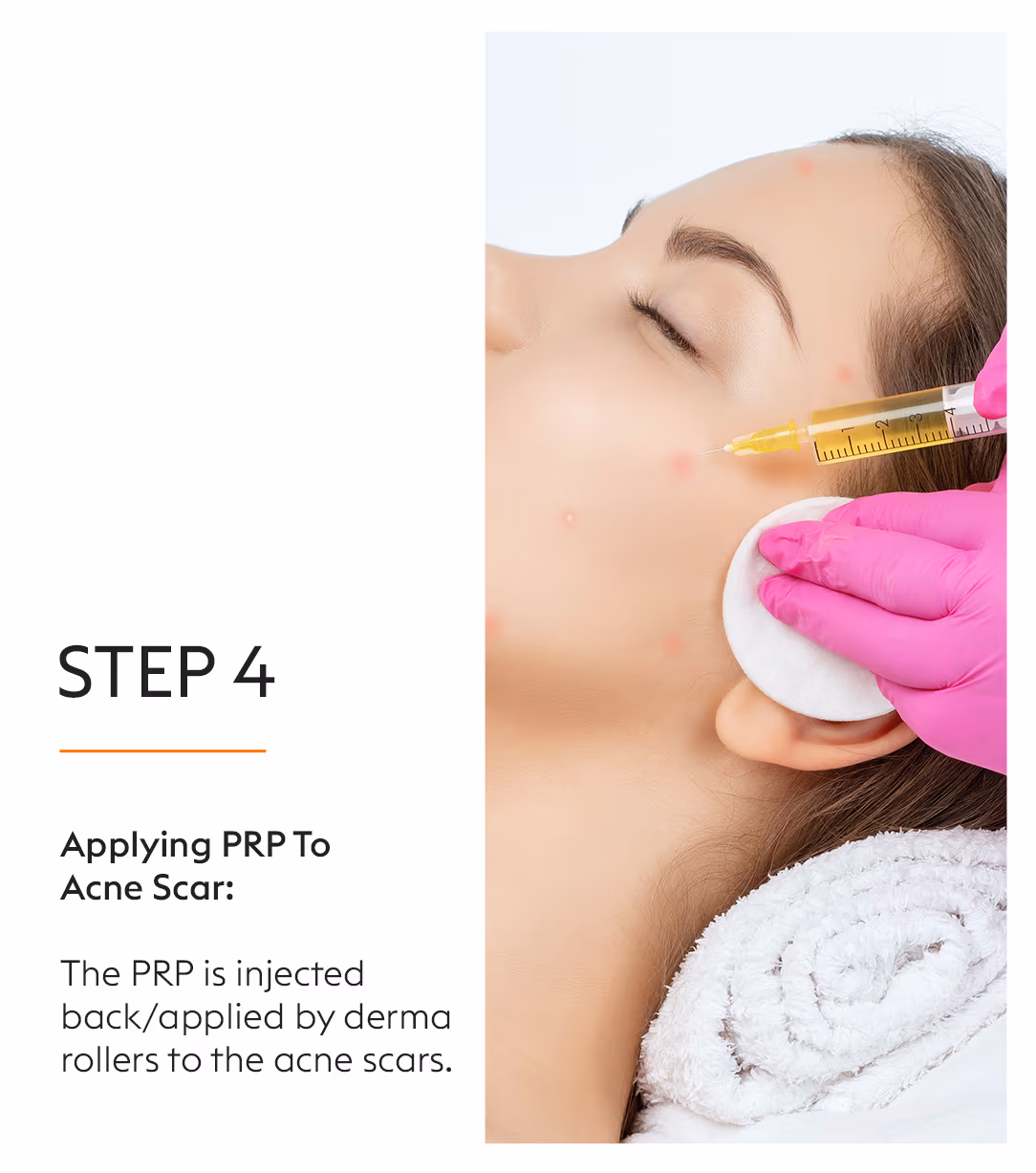 PRP Treatment for Face: Platelet Rich Plasma Therapy at VLCC 6