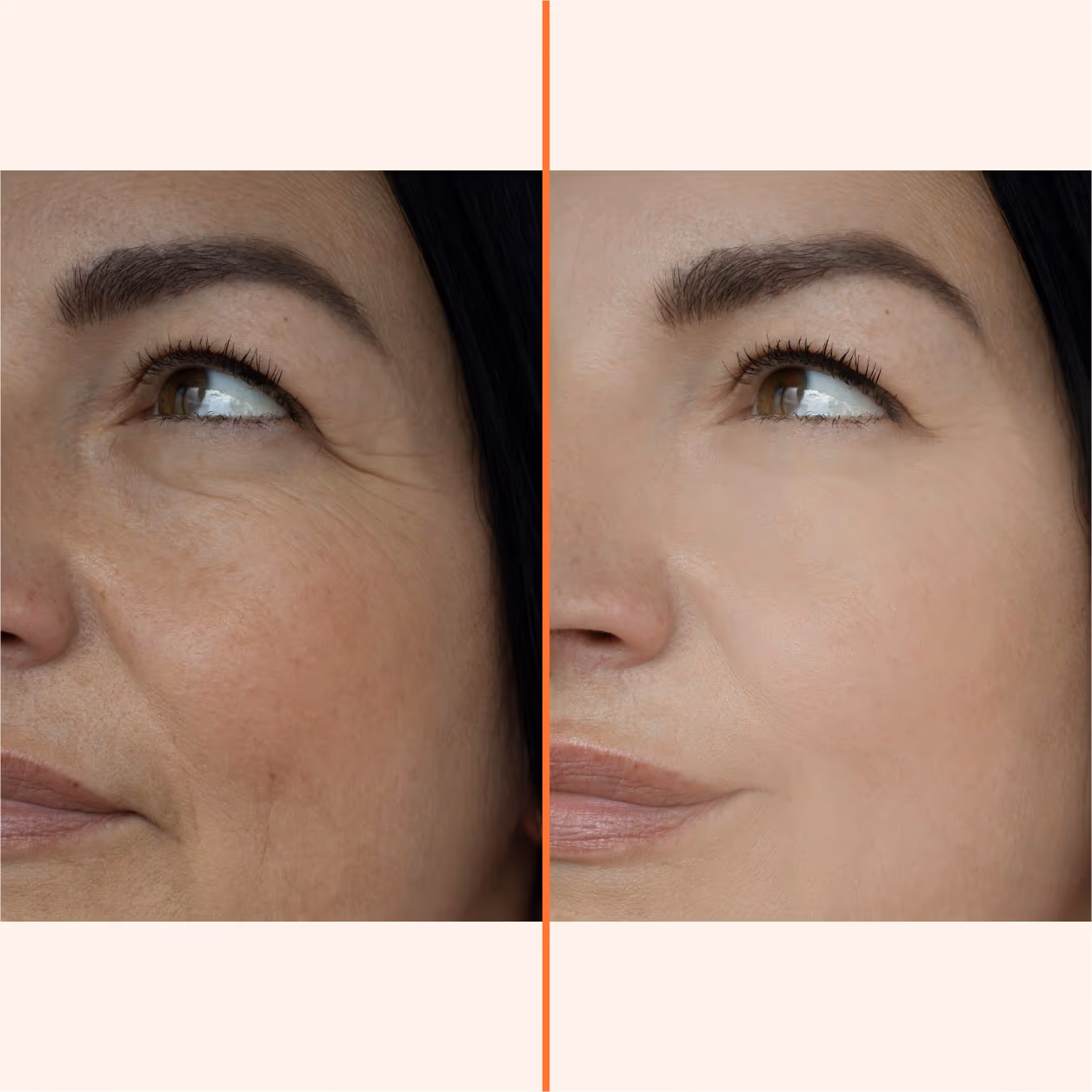3D Filler 1