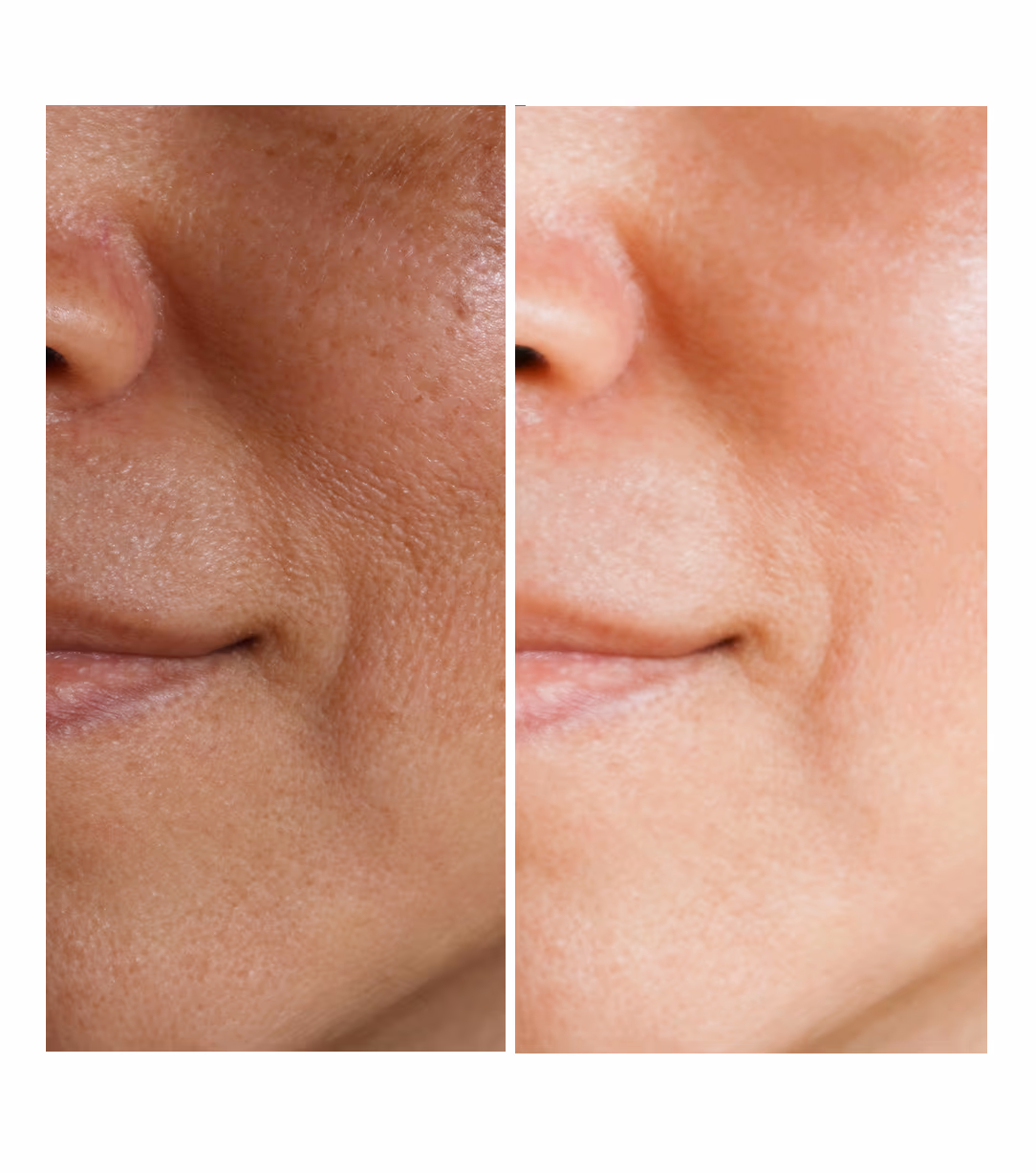 TCA Chemical Peels Skin Whitening Treatment 1