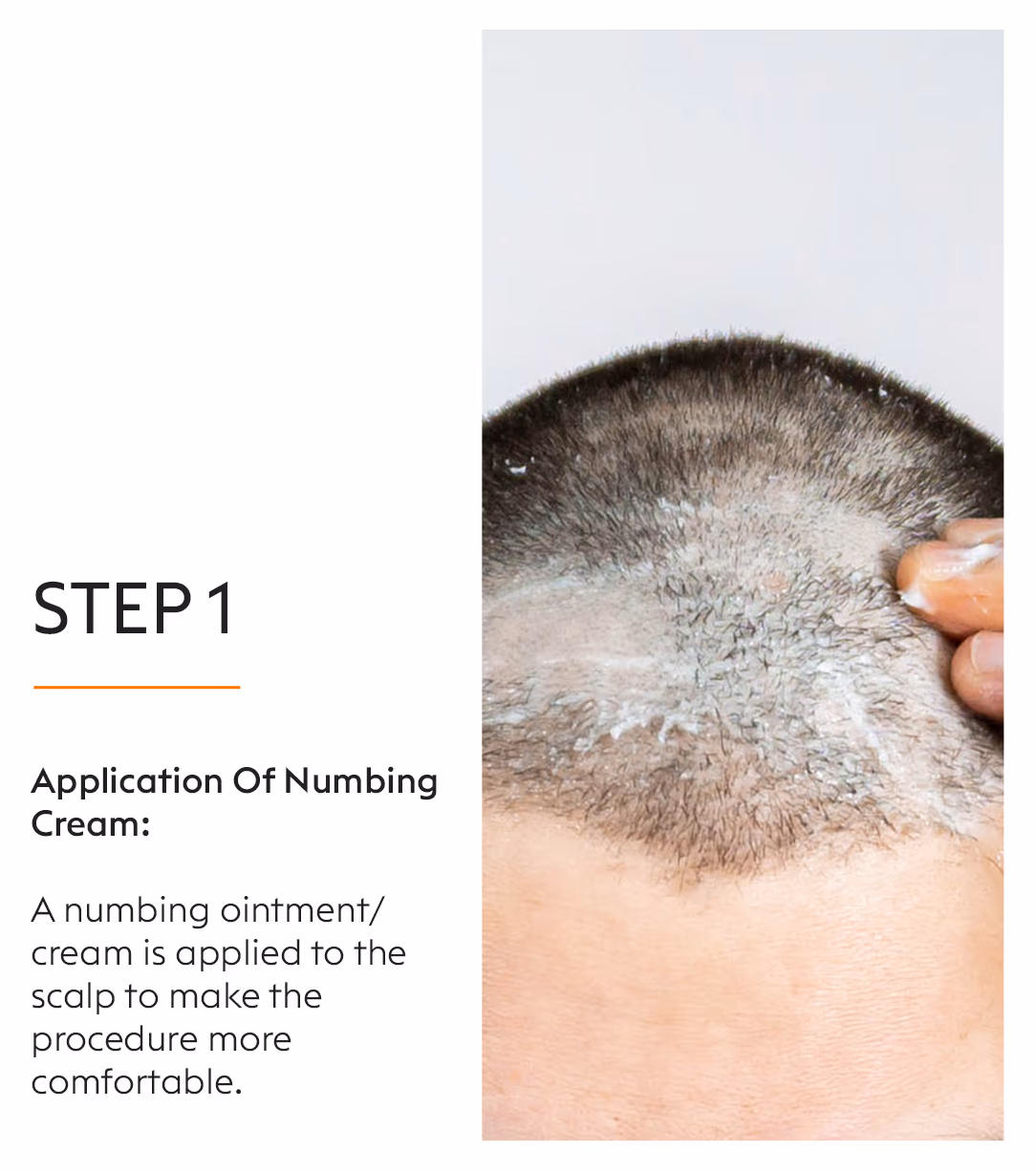 Mesotherapy 3