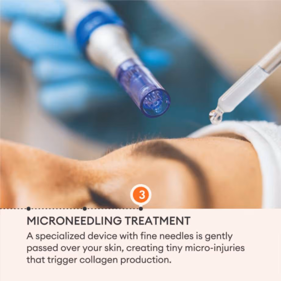 Microneedling 5