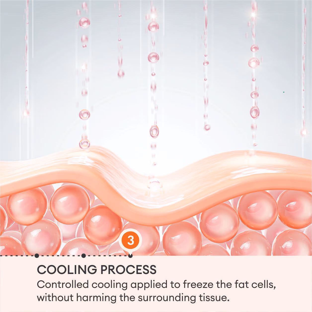 Cryolipolysis (Coolsculpting) Fat Removal 6