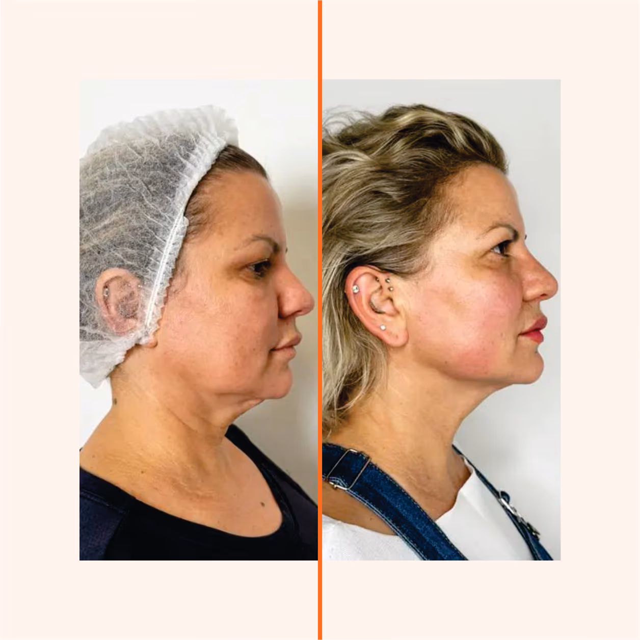 Laser Lipolysis Face 2