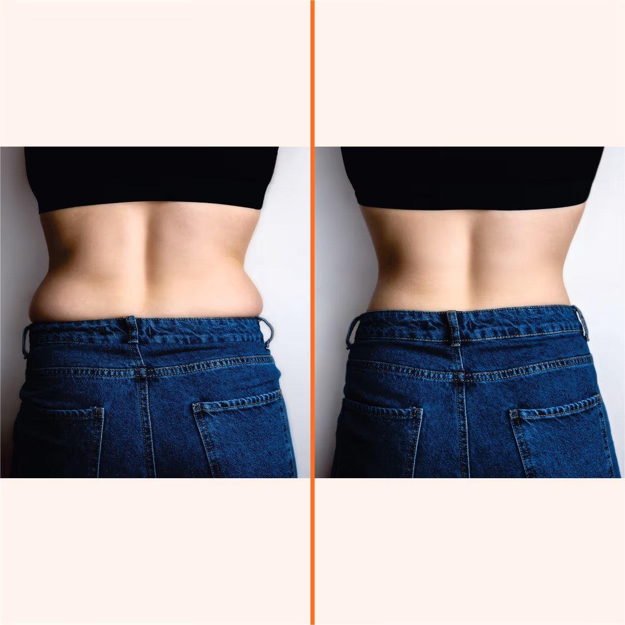Liposuction Surgery 2