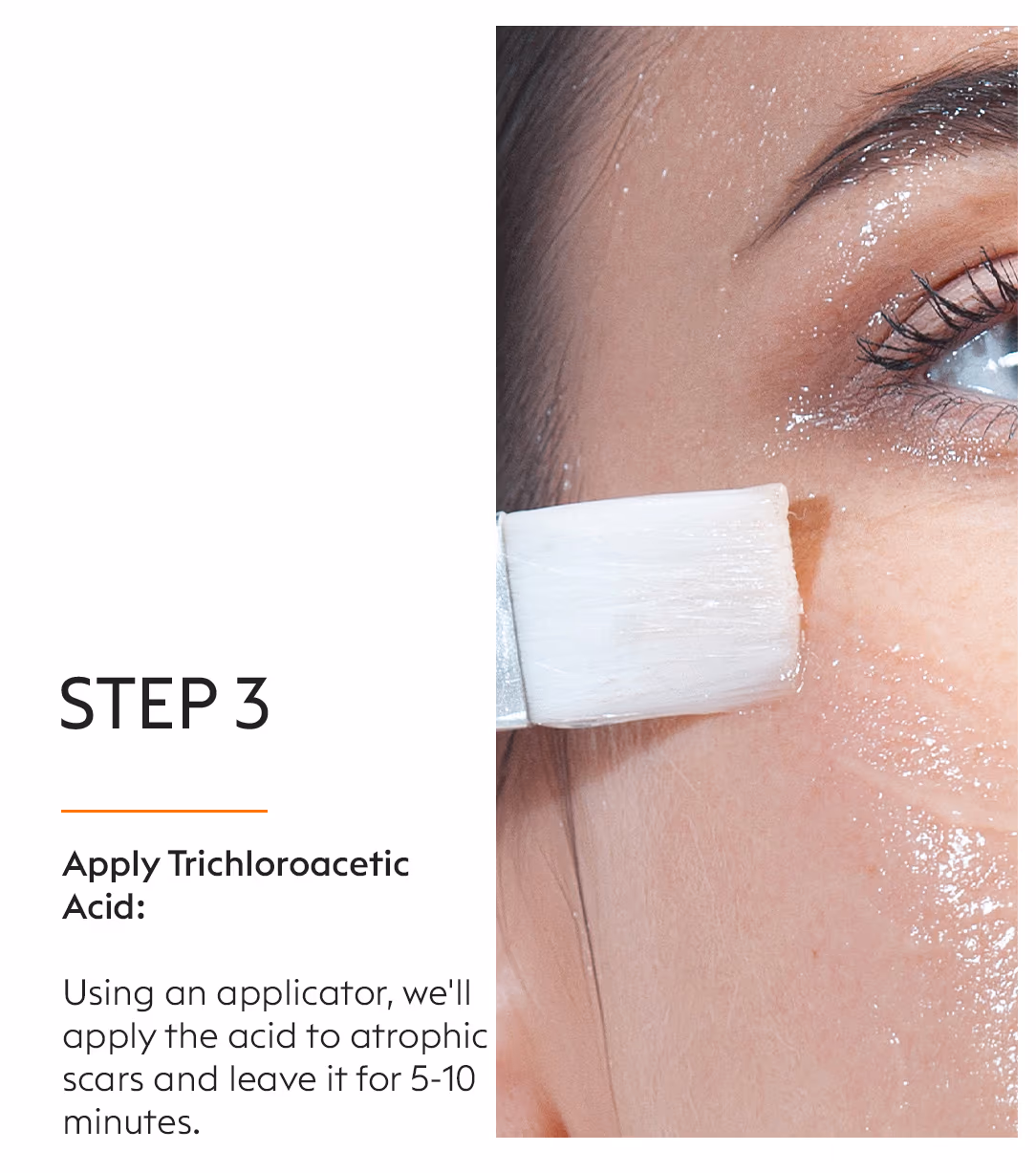 TCA Chemical Peels Skin Whitening Treatment 5