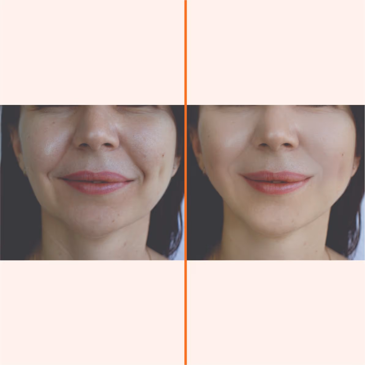 Indiba Face 1