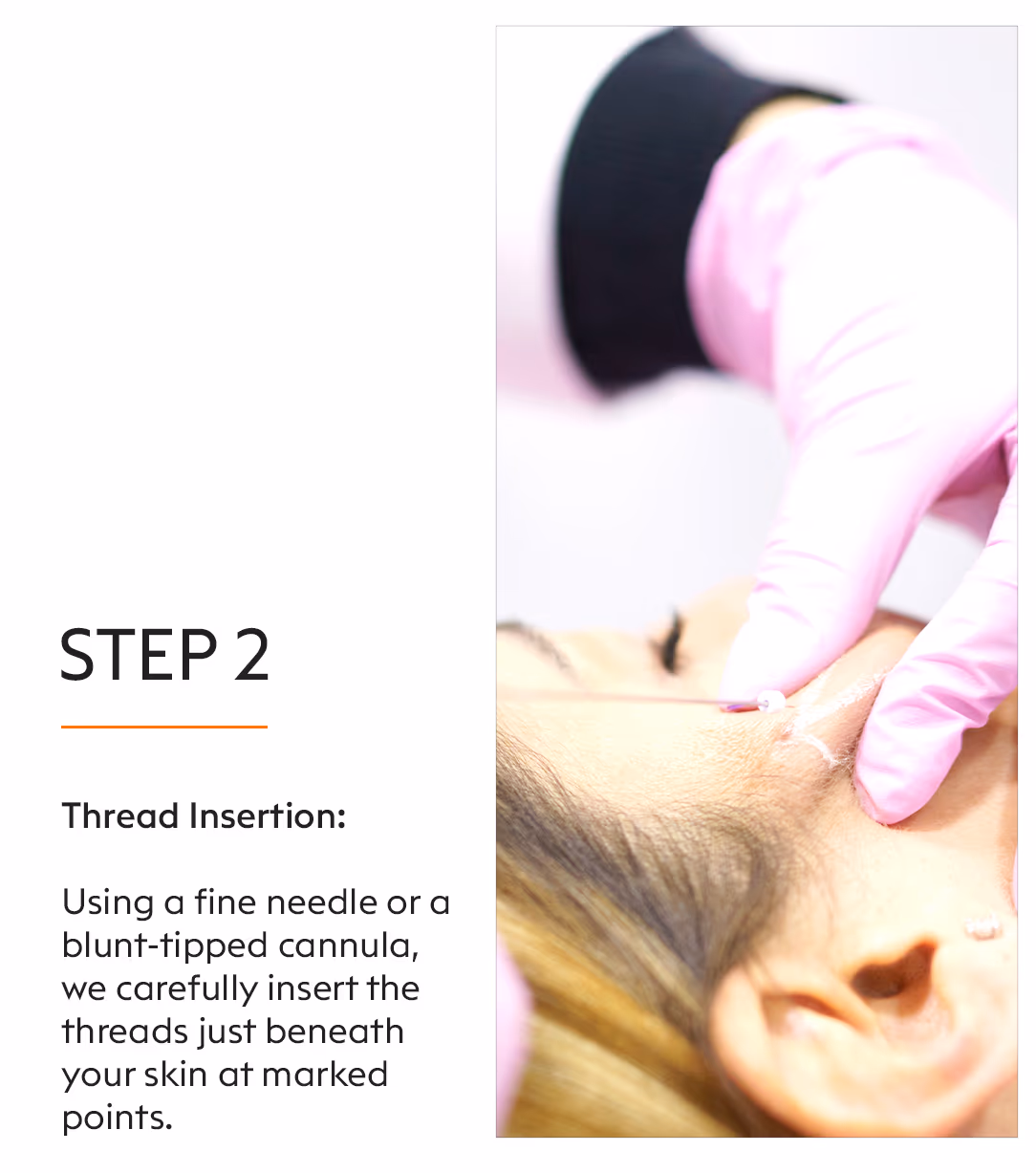 Thread Lift 4