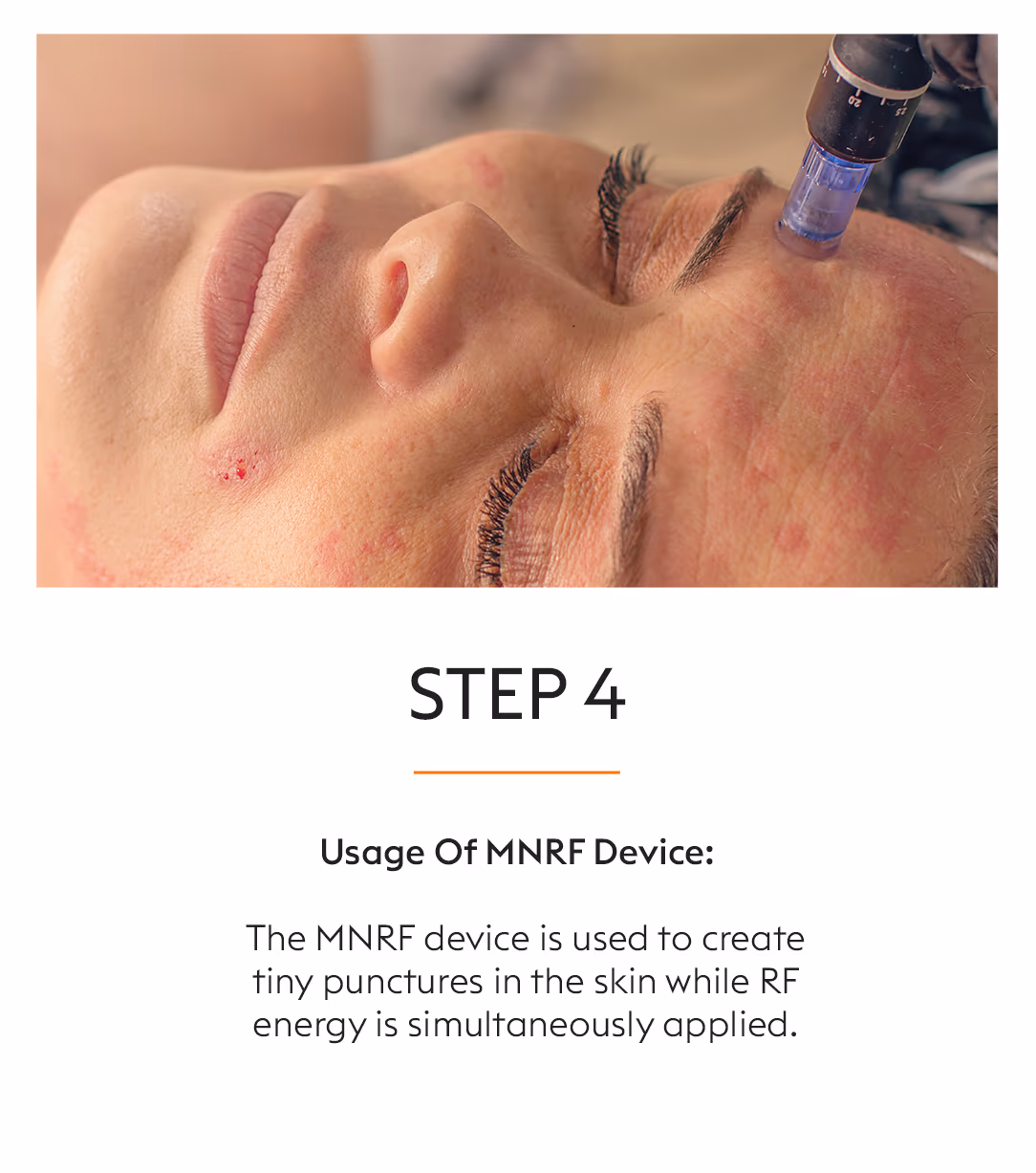 Microneedling and RF 6