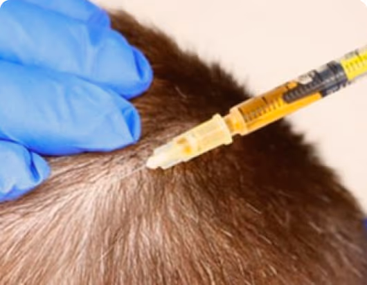 PRP Hair Fall Treatment