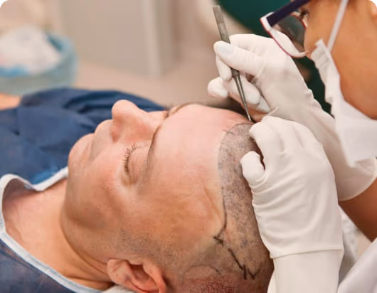 Hair Transplant Hair Fall Treatment