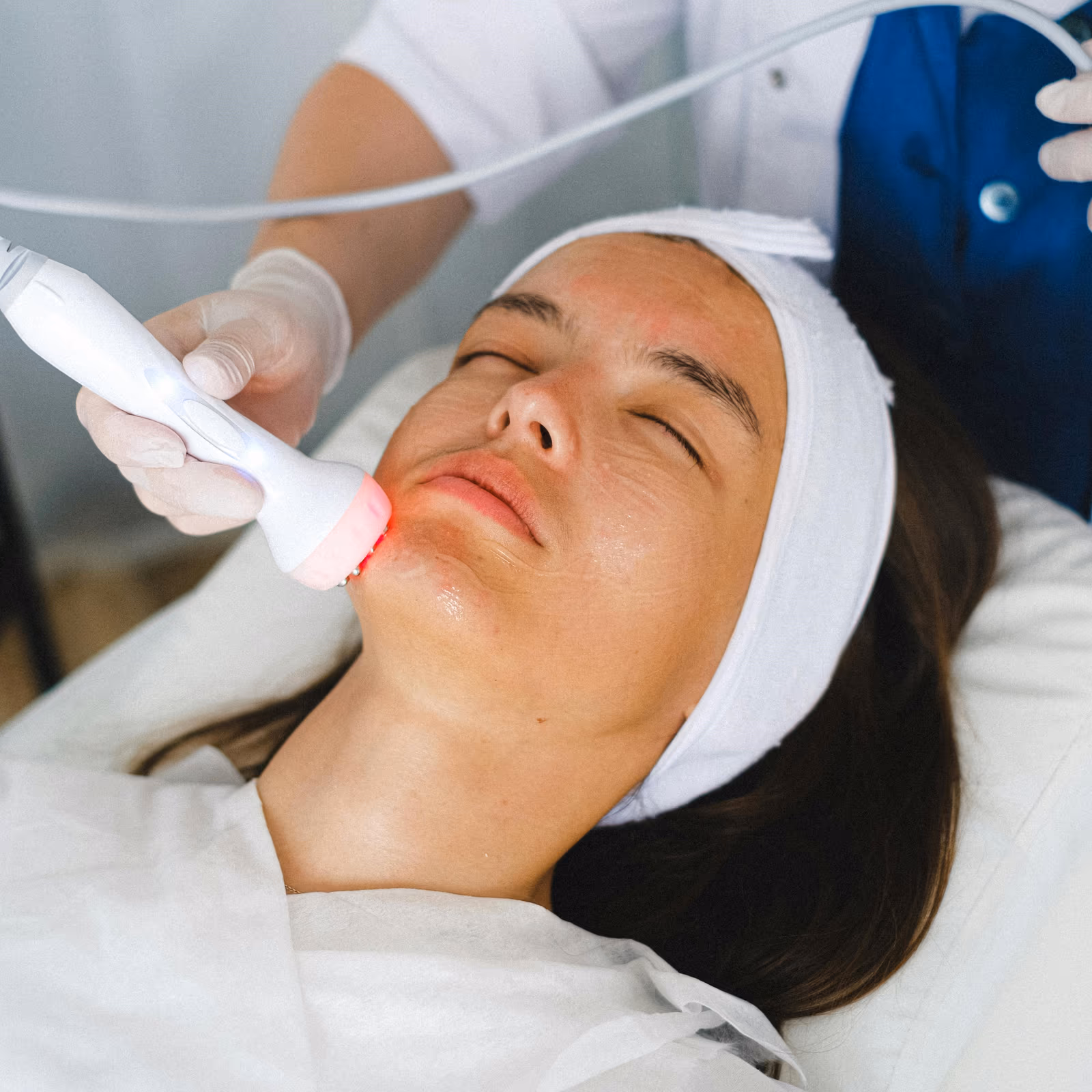 Nd Yag Laser Pigmentation Treatment