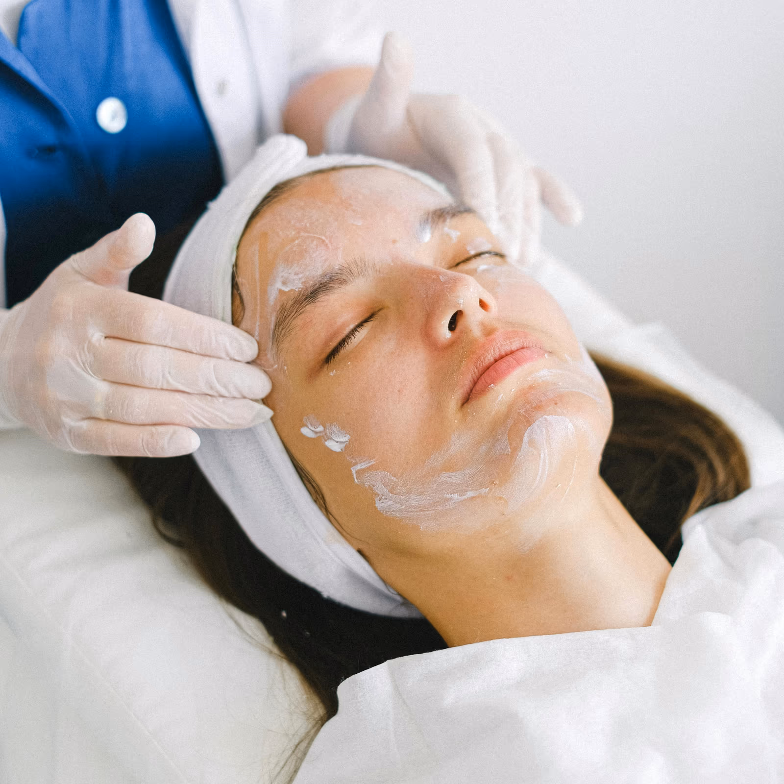TCA Chemical Peels Skin Whitening Treatment