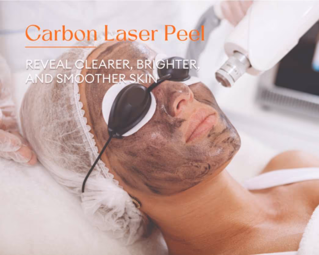Carbon Laser Peel